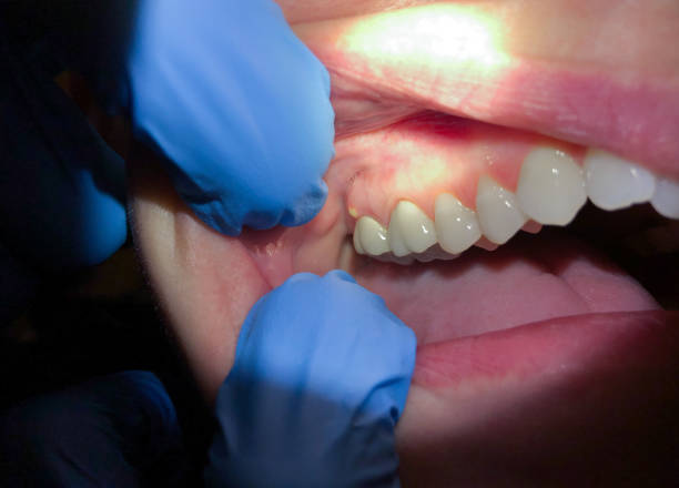Best Emergency Gum Treatment in Paola, KS